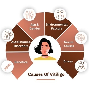 Causes of vitiligo